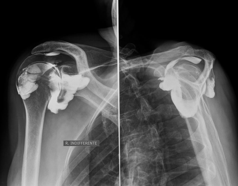 arthrographie-epaule