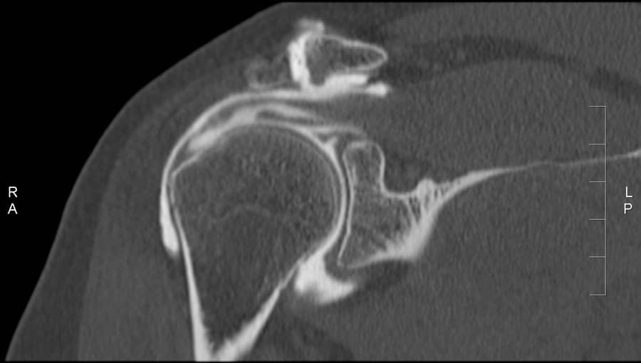 arthrographie-lombaire