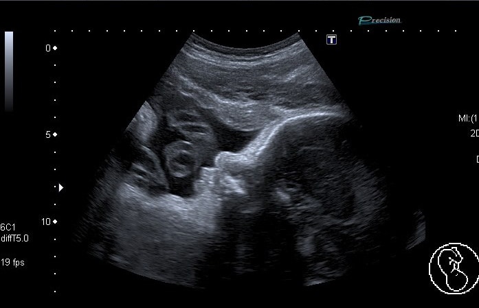 foetus-profil-t3