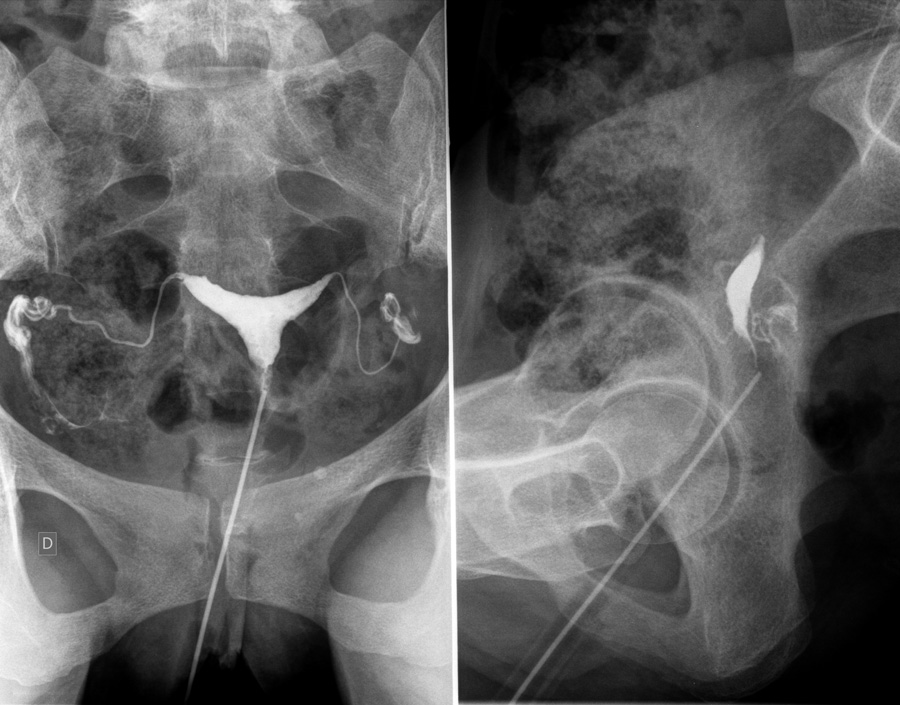 hysterographie