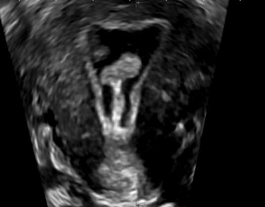 hysterosonographie-2
