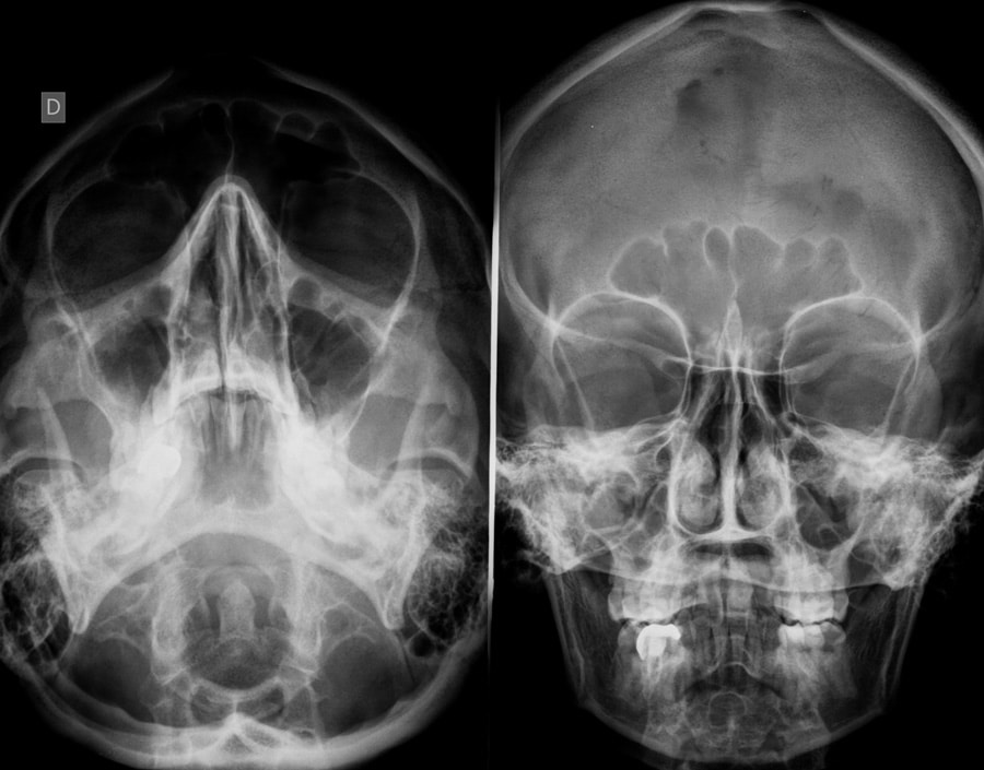 sinus