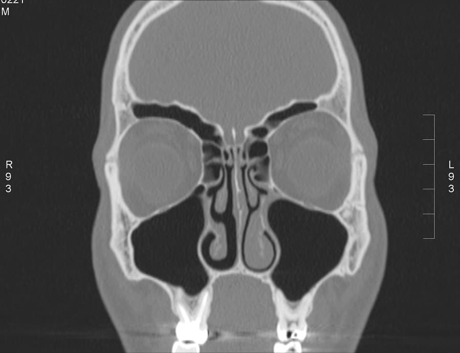 tdmsinus